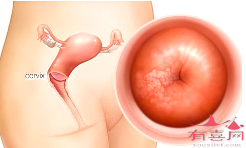 厦门借卵试管-早期宫颈癌的五个迹象，早期发现和早期治疗